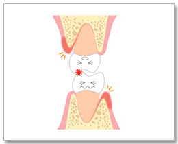 噛み合わせ悪いイラスト