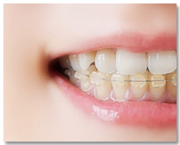 矯正治療イメージ